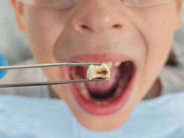 Best Emergency Dentist for Lost Fillings or Crowns in Dasher, GA